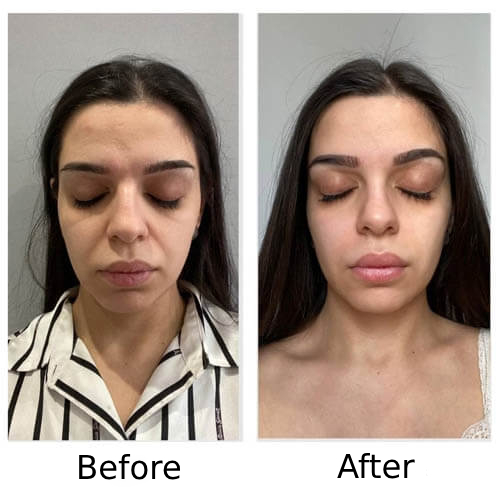 Before and After
