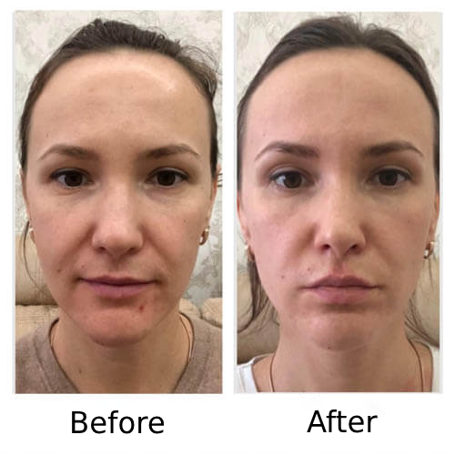 Before and After